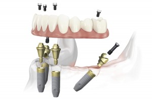 implantatsiya-vsekh-zubov-1-den-razvod-il-5