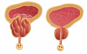 Simptomy-prostatita